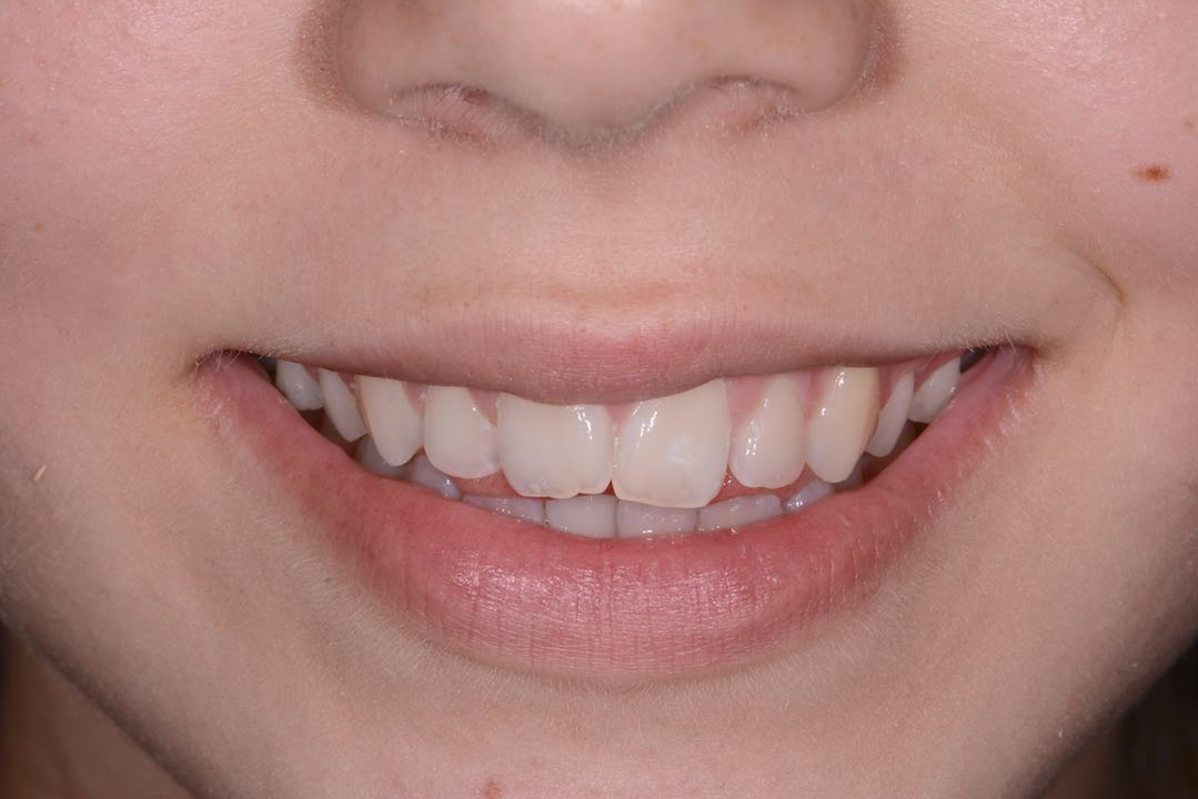 Invisalign i7 Lite West Malling Dental, Kent