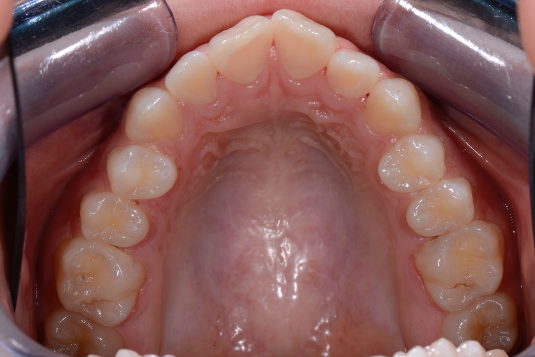 Invisalign i7 Lite West Malling Dental, Kent