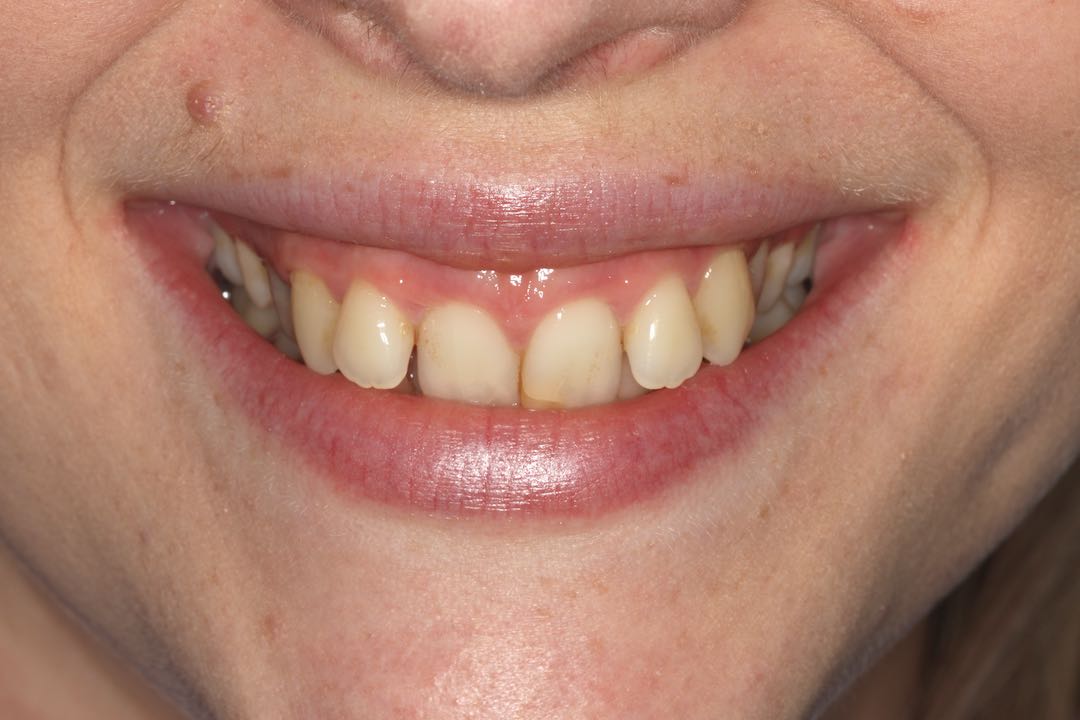 Invisalign i7 Lite West Malling Dental, Kent