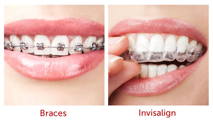 invisalign orthodontics braces orthodontic treatment means dental smile need align without benefits