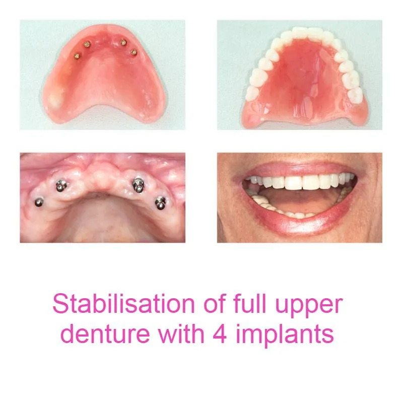 Denture supported by Dental Implants