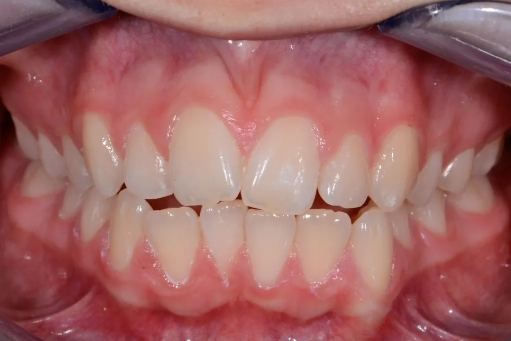 Invisalign front Chantelle  before treatment