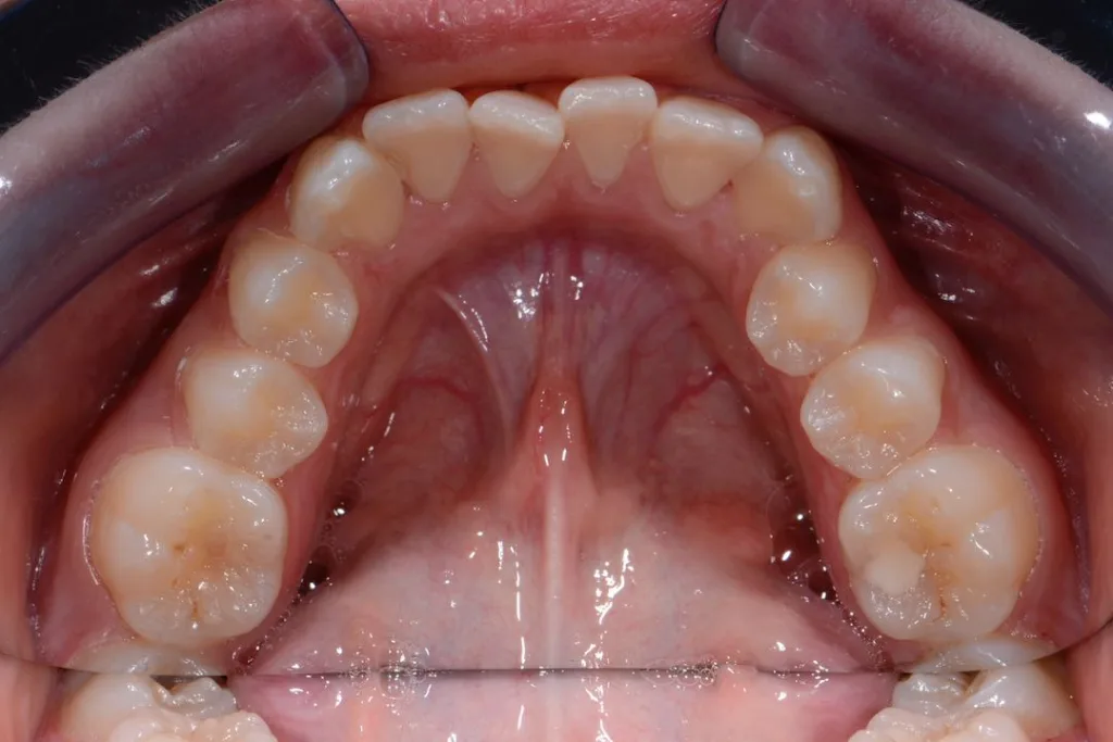 Invisalign lower jaw Chantelle  before treatment