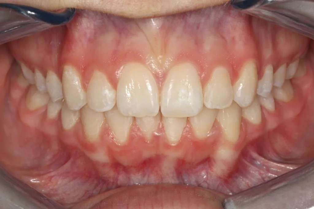 Invisalign front Chantelle  after treatment
