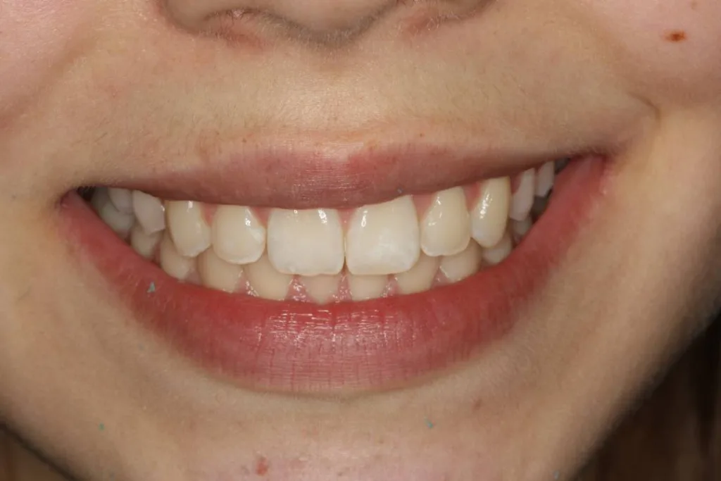 Invisalign smile Chantelle  after treatment