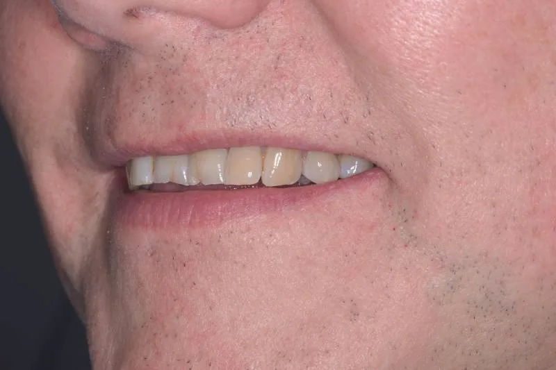 smile after dental implant