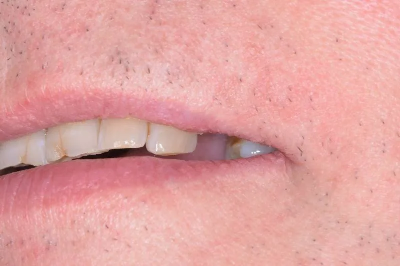Missing tooth before dental implants