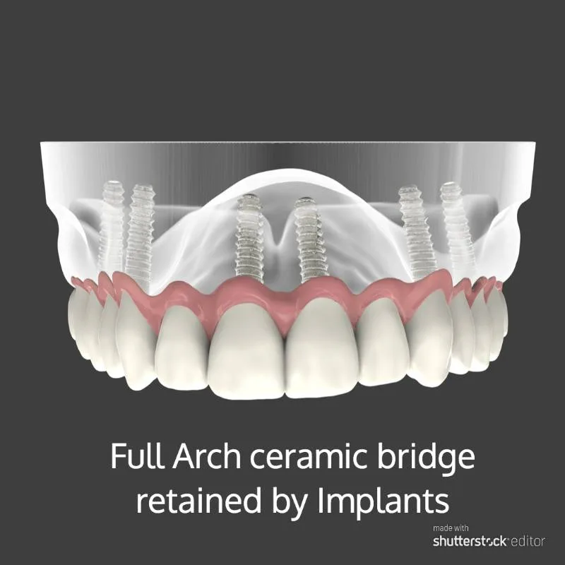 Ceramic bridge retained by implants