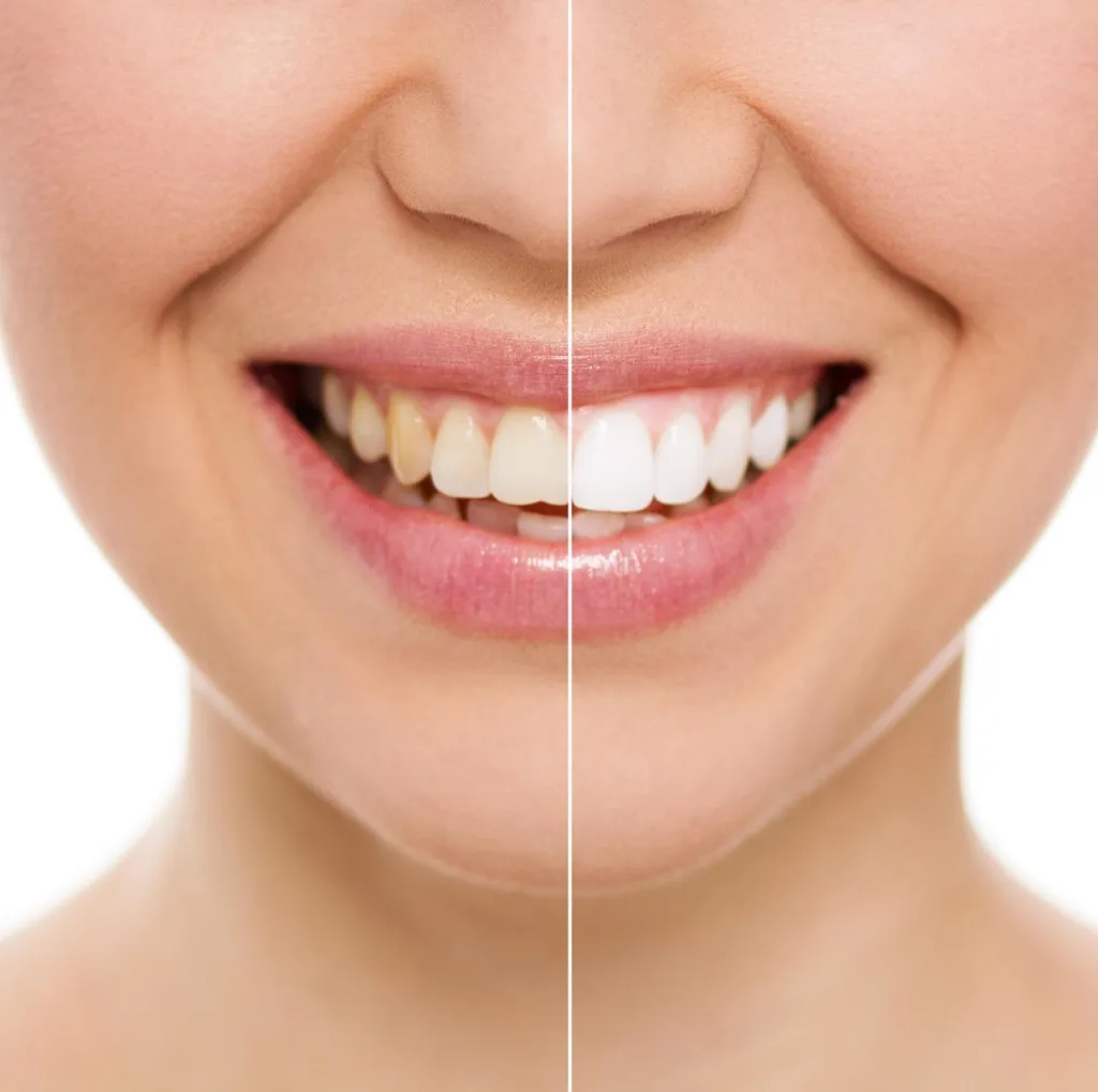 before and after tooth whitening